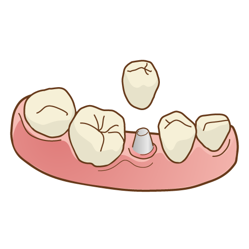 クラウンインレー埋め込みイラスト